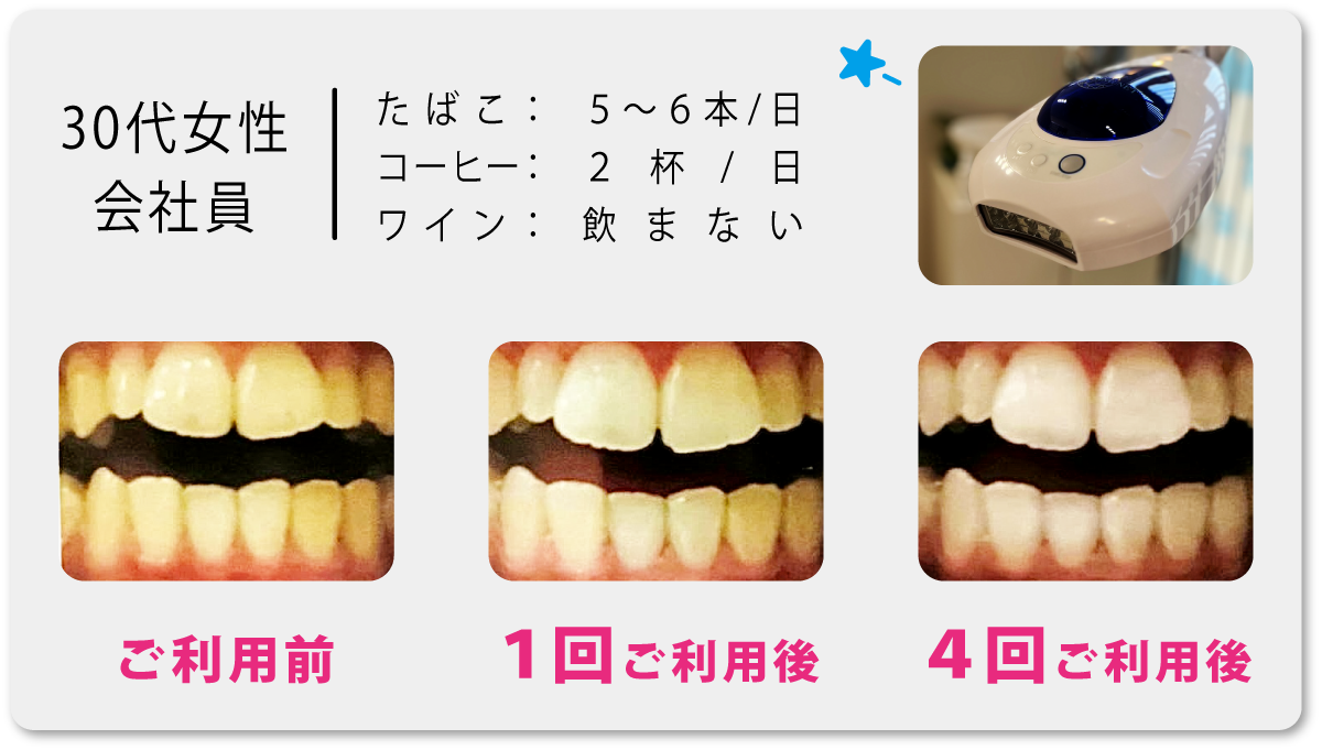 スマイルホワイト、ホワイトニング|スマイルホワイトのホワイトニング効果の事例をご紹介します。
※個人の感想であり、結果を保証するものではありません。、30代、女性、会社員、たばこ5~6本/日、コーヒー2杯/日、ワイン飲まない、ごち用前、1回ご利用後、4回ご利用後